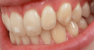 Dental fluorosis mild The Dental Office At Chestnut Hill