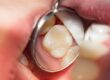 implant restoration dental implants in Chestnut Hill