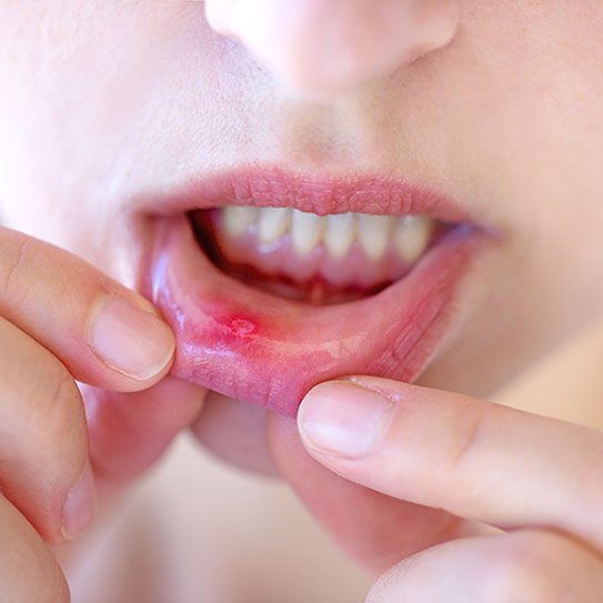 canker sore 2025 543 The Dental Office At Chestnut Hill