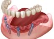 dentists MA implant-retained dentures